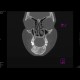Fibrous dysplasia of the mandible: CT - Computed tomography